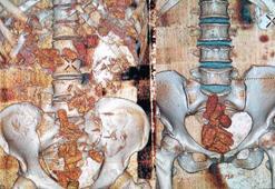 Bağırsaklarındaki uyuşturucu tomografiyle ortaya çıktı