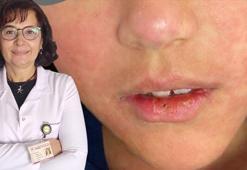 Klimik Başkanı Prof. Dr. Yavuz'dan kızamık salgını uyarısı