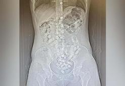 İranlı 2 kadının midelerinden 693,3 gram Afyon sakızı çıktı