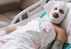 Zift tankındaki patlamada yaralanan işçi: Alevlerin üzerimize geldiğini gördük ve yere düştük