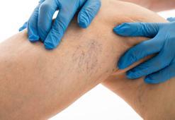 Uzmanı açıkladı: Evden çalışma, erken yaşta varis vakalarını artırıyor