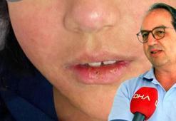 Prof. Dr. Şener, kızamıkta göçmen nüfusa karşı uyardı