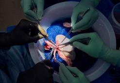 Domuz böbreği, 32 gün boyunca insan vücudunda işlevini yerine getirdi