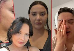 'Badem göz' ameliyatı hayatını kararttı