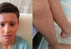 'Balık pulu' hastası Kayra, gündüzleri evden çıkamıyor
