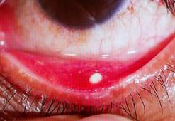 Gözünüzde batma varsa dikkat: Göz taşınız olabilir