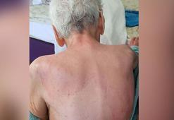 Huzurevindeki ölümde beklenen rapor geldi: Dermatolojik hastalık tespit edilmedi