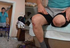 Ayağına batan cam parçasını önemsemeyen diyabet hastası, bacağını kaybetti