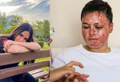 Benzin buharı parlayınca yüzü ve vücudu yanan Beyzanur, sanayideki işine dönmek istiyor
