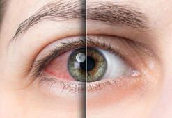 ‘Sürekli göz kaşımak keratokonus hastalığına yol açabilir’