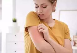 Uzmanından uyuz uyarısı: Ailede herkes tedavi olmazsa yeniden bulaşabilir