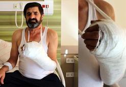 Çatı onarırken kopan eli, mikrocerrahi yöntemiyle dikildi