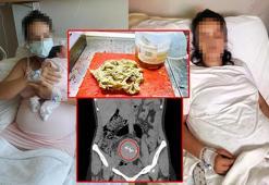 Doğumda annenin vücudunda unutulan gazlı bez, 2 yıl sonra fark edildi