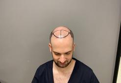 Amerikalı hastalar saç ektirmek için Türkiye’ye geliyor; talep yüzde 150 arttı