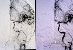 İnmede erken müdahale hayat kurtarıyor