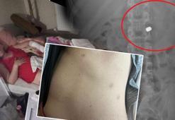 Sevgilisi tarafından 7 kurşunla yaralanan kadın DHA'ya konuştu: Cehennemi yaşadım