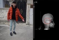 Yusuf, 1,5 aydır başına isabet eden yorgun mermi ile yaşıyor