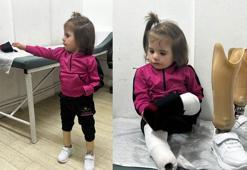 3,5 yaşındaki Tali, protez bacaklarına kavuştu
