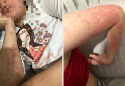 Eczacının otizmli Zeynep'e verdiği muadil ilaç alerjik etki yaptı; baba şikayetçi oldu