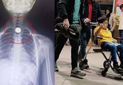 7 yaşındaki Ahmet'in yuttuğu 50 kuruş yemek borusuna takıldı