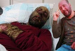 Yağmur ormanlarında yaşayanlarda görülen hastalık, yüzünü tanınmaz hale getirdi