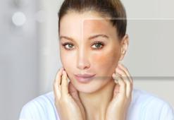 Boyut, şekil ve renk değiştiren cilt lekelerine dikkat: Basit bir leke olmayabilir