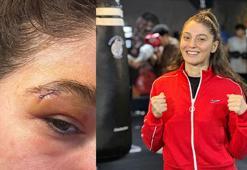 Seren Ay Çetin'in kaşına dikiş atıldı, ünvan maçı ertelendi