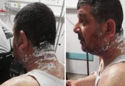 Hatay'da, tartıştığı kiracısına asitle saldırdı