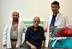 Böbrek ağrısıyla gitti, karnından 8 kiloluk tümör çıkarıldı