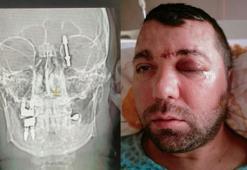 Diş implantı, çene kemiği ile 'orbita tabanı'nı delip, beyin omurilik sıvısına girdi