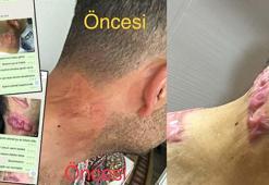 Lazer tedavisi sonrası 'yanık izi belirginleşti' suçlaması
