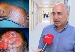 Cilt Kanseri Farkındalık Ayı'nda uzmanından uyarı; yüz bölgesindeki kanser beyne ilerleyebilir