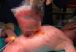 Bağırsakları dışarıda doğan Poyraz bebek, sağlığına kavuştu