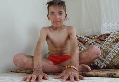 Amar, arkadaşlarının dalga geçtiği deri hastalığından kurtulmak istiyor