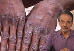 Prof. Dr. Ceyhan'dan 'maymun çiçeği' varyantı uyarısı