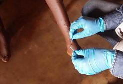 Prof. Dr. Taşova: Maymun çiçeği eski bir hastalık, Covid-19 gibi salgın yapması beklenmiyor