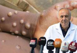 Prof. Dr. Akalın: Maymun çiçeğinde hijyen kuralları önemli