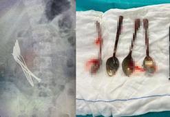 15 yaşındaki çocuğun midesinden 4 kaşık ve 1 çivi çıkarıldı
