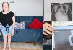 Skolyoz hastası Kardelen: Derecem biraz daha yükselirse, ameliyat şansım da kalmayacak