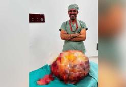 'Karın ağrısı' şikayetiyle gittiği hastanede karnından 26 kiloluk tümör çıktı
