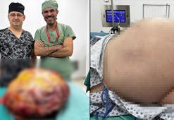 Erkek hastanın karnından 26 kiloluk tümör çıkaran cerrah: Böyle bir kitleyi literatürde hiç göremedim