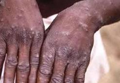 Zimbabve ve Zambiya'da ilk Maymun çiçeği vakaları tespit edildi