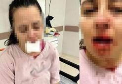 Balyozla saldırdığı yeğeninin çenesini ve 1 dişini kırdı