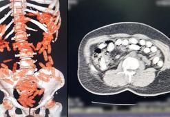 Midesinden yaklaşık 1 kilo uyuşturucu çıktı