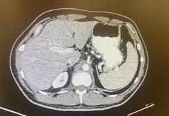 26 kadavra üzerinde mikroplastik araştırması; kan dolaşımı ile vücuda yayılıyor