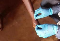 DSÖ, Maymun Çiçeği aşısına acil kullanım onayı verdi