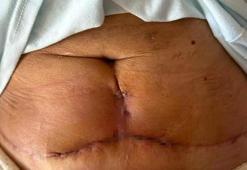 Kol ve karın germe ameliyatı oldu, dikiş izleri kaldı