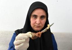 Ameliyatta karnında unutulan makas, 7 yıl sonra baş ağrısıyla ortaya çıktı