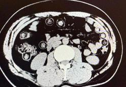 İran uyruklu 2 şüphelinin midelerinde 94 kapsül halinde metamfetamin çıkarıldı