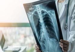 'Solunum yolu enfeksiyonları nedeniyle yoğun bakıma yatışlarda artış var'